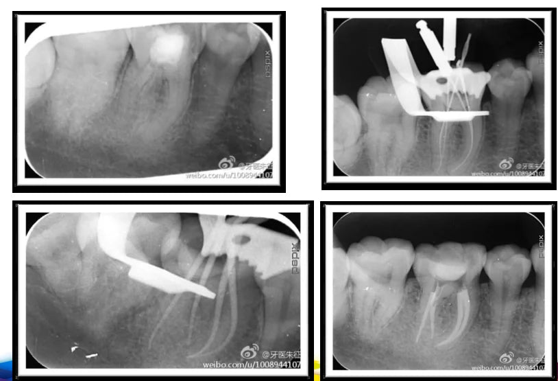 Dental X3 endo Rotary Files Endodontic NITI